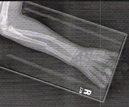 5-25-06 Wesley's X-Ray - ouch!